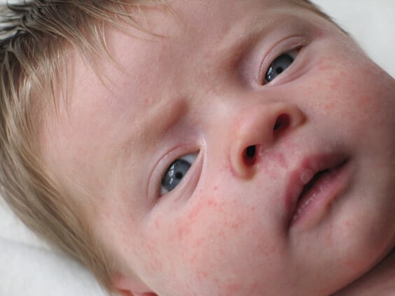 תינוק עם פריחה על העור